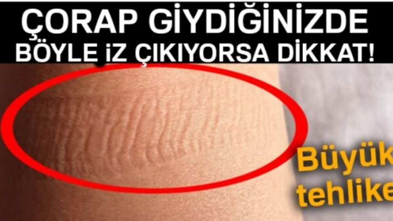 ÇORAP GİYDİĞİNİZDE BÖYLE İZ ÇIKIYORSA DİKKAT !